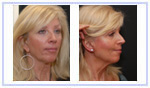 Rhinoplasty