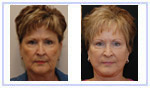 Facelift
