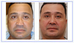 Revision Rhinoplasty