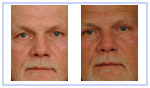 Blepharoplasty