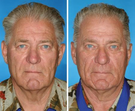twins: smoker, non-smoker twins: smoker, non-smoker