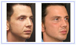 Cheek Augmentation