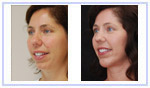 Facelift