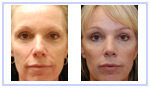 Blepharoplasty
