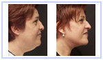 Facelift