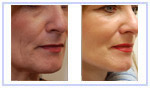 Facelift