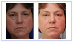 Botox&reg;