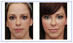 Facelift