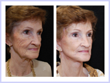 Facelift