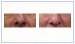 Rhinoplasty