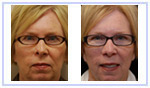 Facelift