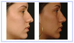 Rhinoplasty