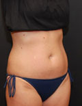 After Liposonix Cincinnati After Liposonix Cincinnati