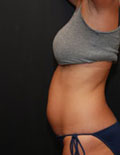 Before Liposonix Ohio Before Liposonix Ohio