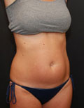 Before Liposonix Cincinnati Before Liposonix Cincinnati