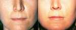 Lip Augmentation in Cincinnati - Before & After