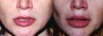 Lip Augmentation in Cincinnati - Before & After