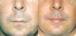 Lip Augmentation in Cincinnati - Before & After