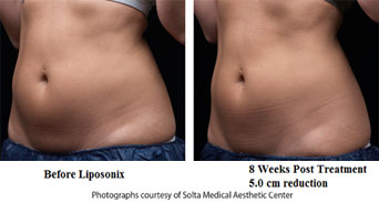 Before and after patient image of Liposonix® Fat Removal in Cincinnati