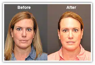 Before and After Kybella