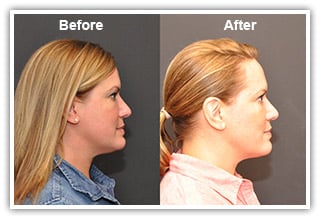 Before and After Kybella