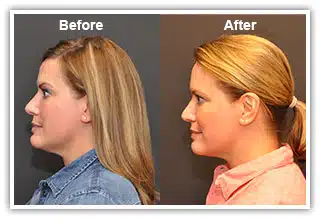 Before and After Kybella