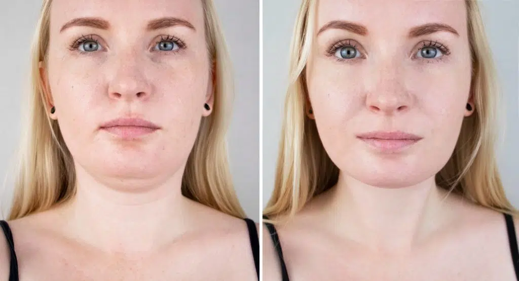 Double chin can be caused by aging, stress, and a poor diet