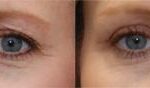 Blepharoplasty Before and After Photos in Cincinnati, OH, Patient 5454
