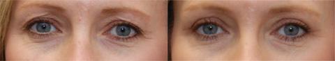 Blepharoplasty Before and After Photos in Cincinnati, OH, Patient 5454