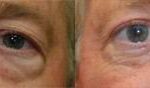 Blepharoplasty Before and After Photos in Cincinnati, OH, Patient 5457
