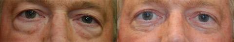 Blepharoplasty Before and After Photos in Cincinnati, OH, Patient 5457