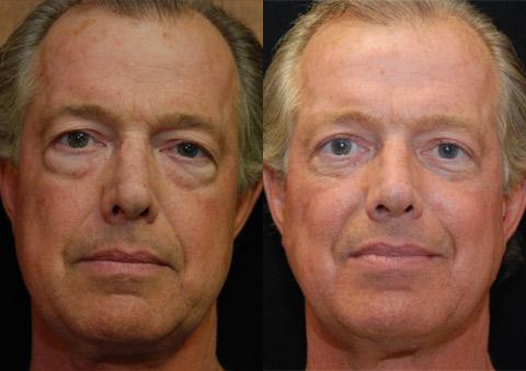 Blepharoplasty Before and After Photos in Cincinnati, OH, Patient 5457