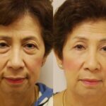 Blepharoplasty Before and After Photos in Cincinnati, OH, Patient 5462