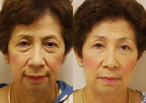 Blepharoplasty Before and After Photos in Cincinnati, OH, Patient 5462