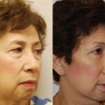 Blepharoplasty Before and After Photos in Cincinnati, OH, Patient 5462