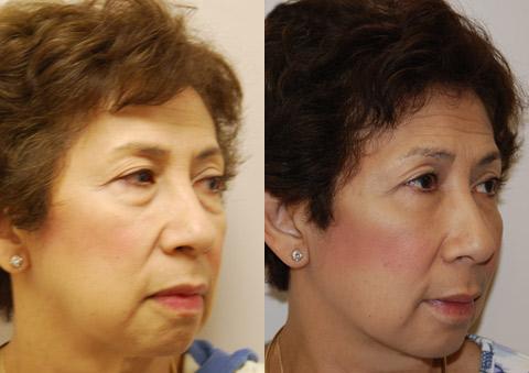 Blepharoplasty Before and After Photos in Cincinnati, OH, Patient 5462