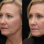 Blepharoplasty Before and After Photos in Cincinnati, OH, Patient 5467