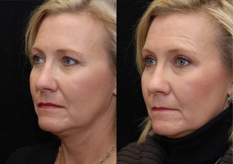 Blepharoplasty Before and After Photos in Cincinnati, OH, Patient 5467