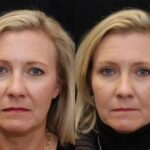 Blepharoplasty Before and After Photos in Cincinnati, OH, Patient 5467