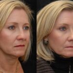Blepharoplasty Before and After Photos in Cincinnati, OH, Patient 5467