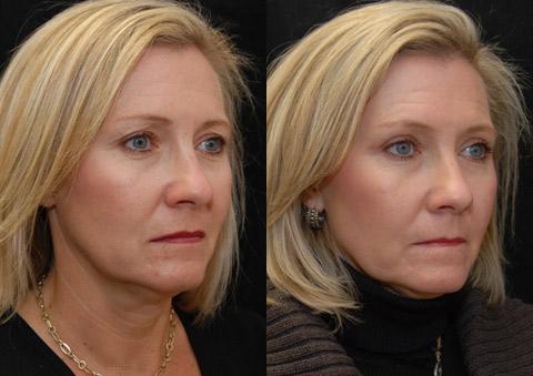 Blepharoplasty Before and After Photos in Cincinnati, OH, Patient 5467