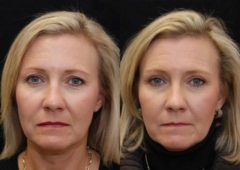 Blepharoplasty Before and After Photos in Cincinnati, OH, Patient 5467