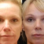 Blepharoplasty Before and After Photos in Cincinnati, OH, Patient 5474