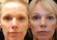 Blepharoplasty Before and After Photos in Cincinnati, OH, Patient 5474