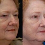 Blepharoplasty Before and After Photos in Cincinnati, OH, Patient 5477