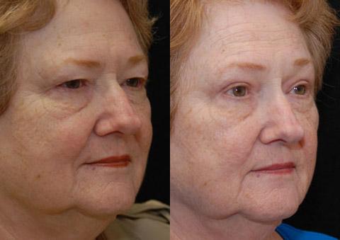 Blepharoplasty Before and After Photos in Cincinnati, OH, Patient 5477