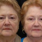 Blepharoplasty Before and After Photos in Cincinnati, OH, Patient 5477