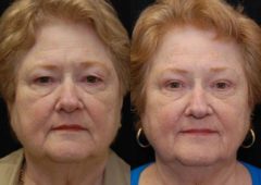 Blepharoplasty Before and After Photos in Cincinnati, OH, Patient 5477