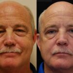 Blepharoplasty Before and After Photos in Cincinnati, OH, Patient 5482