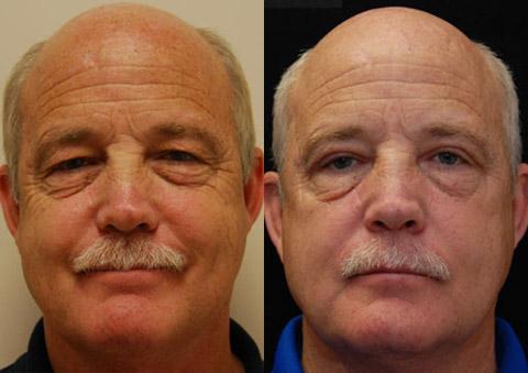 Blepharoplasty Before and After Photos in Cincinnati, OH, Patient 5482